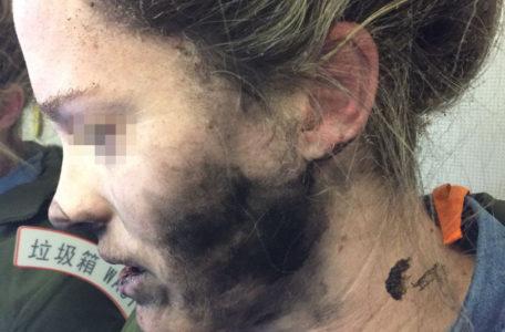 Пассажирка рейса "Пекин – Мельбурн", получившая ожоги лица из-за взрыва батареи в ее наушниках